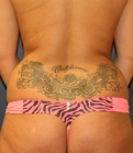 Feel Beautiful - Reduction of Hip Bulges - Before Photo