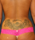 Feel Beautiful - Reduction of Hip Bulges - After Photo