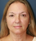 Feel Beautiful - Liposuction Jowls and Neck - After Photo