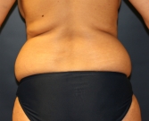 Feel Beautiful - Thinner Flanks and Waist by Liposuction - Before Photo