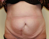 Feel Beautiful - Tummy Tuck Case 15 - Before Photo