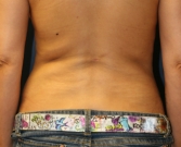 Feel Beautiful - Thinner Flanks and Waist by Liposuction - After Photo