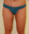 Feel Beautiful - Thinner Thighs - Longer Legs - After Photo