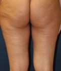 Feel Beautiful - Thigh-Gap-Surgery-Liposuction - Before Photo