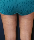 Feel Beautiful - Thigh-Gap-Surgery-Liposuction - After Photo