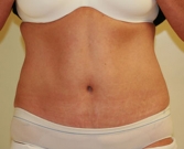 Feel Beautiful - Tummy Tuck Case 15 - After Photo