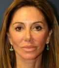 Feel Beautiful - Face Lift Rejuvenation San Diego - After Photo