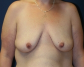 Feel Beautiful - Breast Augmentation-Lift 22 - Before Photo