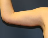 Feel Beautiful - Arm Lift San Diego 9 - After Photo