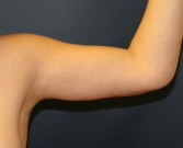 Feel Beautiful - Arm Lift San Diego 10 - After Photo