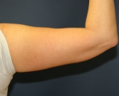 Feel Beautiful - Arm Lift San Diego 11 - After Photo