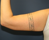 Feel Beautiful - Arm Lift San Diego 12 - After Photo