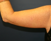 Feel Beautiful - Arm Lift San Diego 14 - After Photo