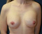 Feel Beautiful - Breast-Lift-with-Implants-23 - After Photo