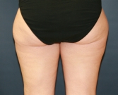 Feel Beautiful - Liposuction Inner and Outer Thighs - Before Photo