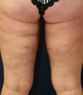 Feel Beautiful - Thigh Lift San Diego - After Photo