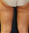 Feel Beautiful - Thigh Lift/Thigh Gap - After Photo