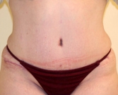 Feel Beautiful - Tummy Tuck Case 18 - After Photo