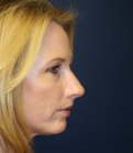 Feel Beautiful - Rhinoplasty (Nose) Natural Change - Before Photo