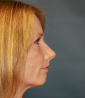 Feel Beautiful - Rhinoplasty (Nose) Natural Change - After Photo
