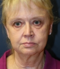 Feel Beautiful - Facelift (Comprehensive) San Diego - Before Photo