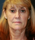 Feel Beautiful - Face and Neck Lift without Browlift - Before Photo