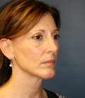Feel Beautiful - Chin Implant with Neck Liposuction - After Photo
