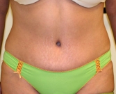 Feel Beautiful - Tummy Tuck Case 13 - After Photo