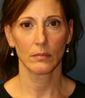 Feel Beautiful - Neck Liposuction & Chin Implant - After Photo