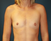 Feel Beautiful - Athletic Breast Augmentation - Before Photo