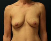 Feel Beautiful - Tall Breast Augmentation - Before Photo