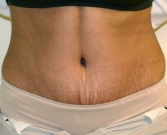 Feel Beautiful - Tummy Tuck Case 19 - After Photo