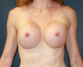 Feel Beautiful - High (Full) Profile Breast Augmentation - After Photo
