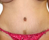 Feel Beautiful - Tummy Tuck Case 20 - After Photo