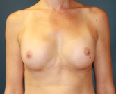 Feel Beautiful - Breast-Augmentation-104 - After Photo