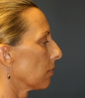 Feel Beautiful - Rhinoplasty (nose re-shaping) 48 - Before Photo