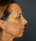 Feel Beautiful - Rhinoplasty (nose re-shaping) 48 - After Photo