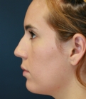 Feel Beautiful - Rhinoplasty (nose re-shaping) 49 - Before Photo