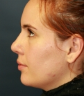 Feel Beautiful - Rhinoplasty (nose re-shaping) 49 - After Photo