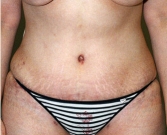 Feel Beautiful - Tummy Tuck Case 21 - After Photo