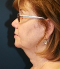 Feel Beautiful - Neck and Lower Face Lift - Before Photo