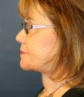 Feel Beautiful - Neck and Lower Face Lift - After Photo