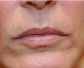 Feel Beautiful - Lips filled with 1 ml Juvederm - Before Photo