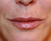 Feel Beautiful - Lips filled with 1 ml Juvederm - After Photo