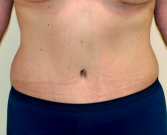 Feel Beautiful - Tummy Tuck Case 22 - After Photo