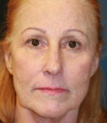 Feel Beautiful - Laser Skin Tightening and Jowl Removal - Before Photo