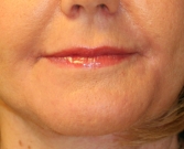 Feel Beautiful - Lip Corner Lift and Lip Laser Treatment - After Photo