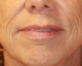 Feel Beautiful - Laser of Lips and Corner Lift - Before Photo