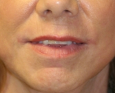 Feel Beautiful - Laser of Lips and Corner Lift - After Photo