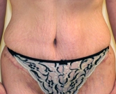 Feel Beautiful - Tummy Tuck Case 24 - After Photo